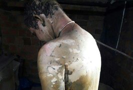 Arapiraquense que teve 80% do corpo queimado morre na UE do Agreste
