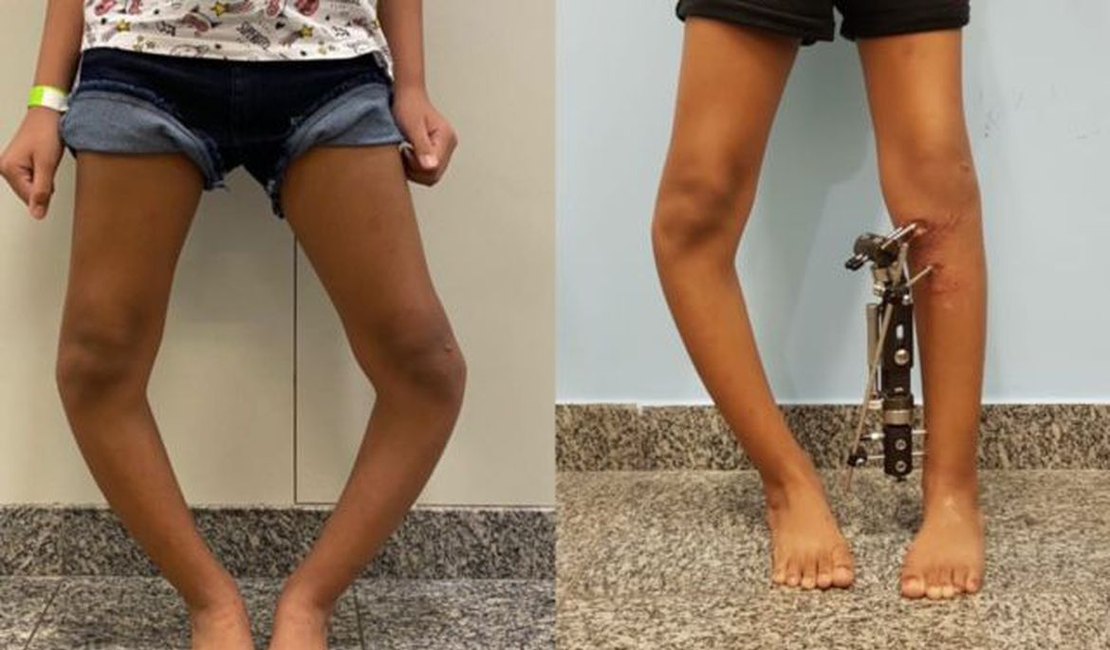 Técnica inovadora corrige deformidades nas pernas de crianças e jovens