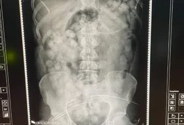 PF prende homem com estômago lotado de cocaína em aeroporto