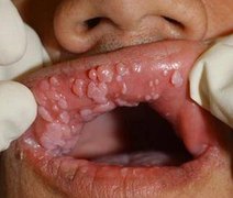 HPV é responsável por 70% dos casos de câncer de colo de útero