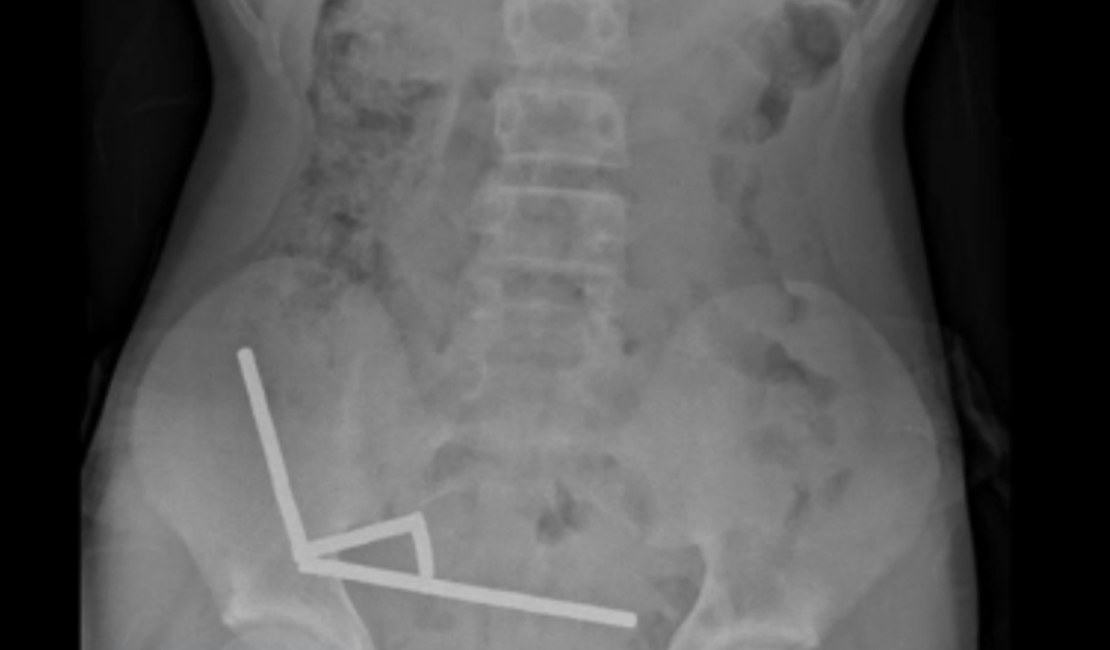 Menino de 13 anos perde parte do intestino após engolir mais de 80 ímãs