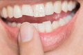 Quebrou o dente? O que fazer nos primeiros minutos para salvar o sorriso?