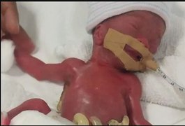 Bebê que nasceu com peso de uma maçã tem alta após 13 meses, em Cingapura