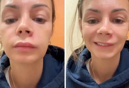 Influenciadora espreme espinha no ‘triângulo da morte’ e vai parar no hospital
