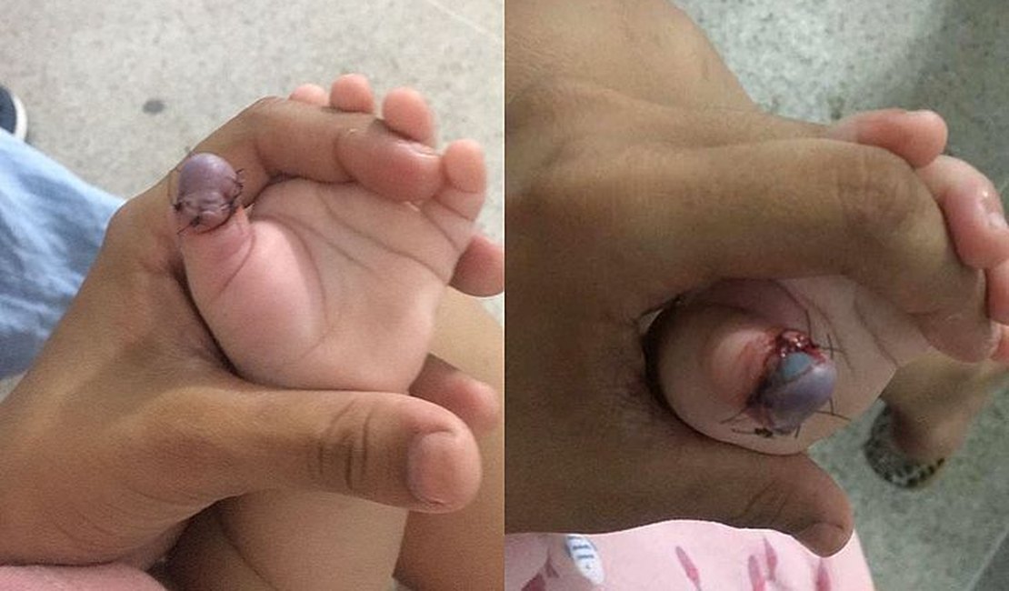 Família afirma que bebê pode ter dedo amputado após esperar três dias por cirurgia