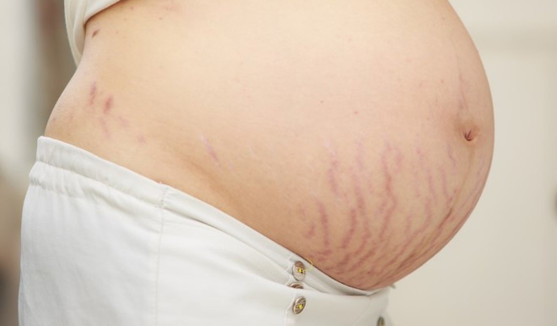 Coçar a barriga na gravidez causa mesmo estria?