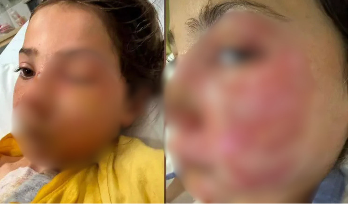 Menina de 10 anos sofre queimaduras graves no rosto após reproduzir desafio viral de rede social