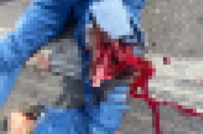 Homem tem parte de perna amputada no HEA após colisão no Agreste de Alagoas