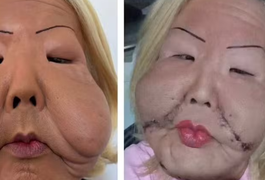 Veja o antes e depois do rosto da Juju do Pix após primeira cirurgia de reconstituição facial