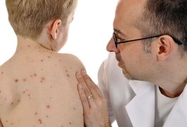 Organização Mundial da Saúde diz que sarampo está eliminado do Brasil