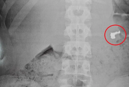 Menor engole cordão de ouro para escapar de ser apreendido após furto
