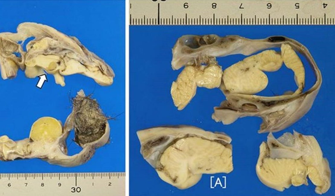 A operação de apendicite que descobriu um pedaço de cérebro, ossos e pelos em um ovário