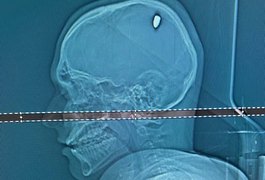 Estudante é atingido por bala perdida na cabeça e só descobre 4 dias depois