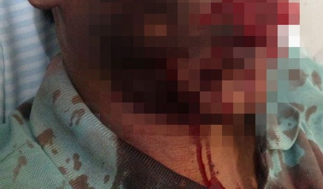 Homem vítima de explosão de aparelho celular continua em estado estável, em AL
