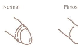 Você tem fimose? O que é a condição que transforma o sexo em agonia para milhares de homens