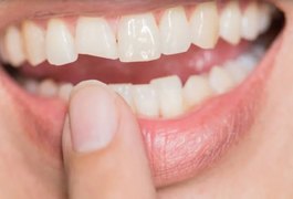 Quebrou o dente? O que fazer nos primeiros minutos para salvar o sorriso?