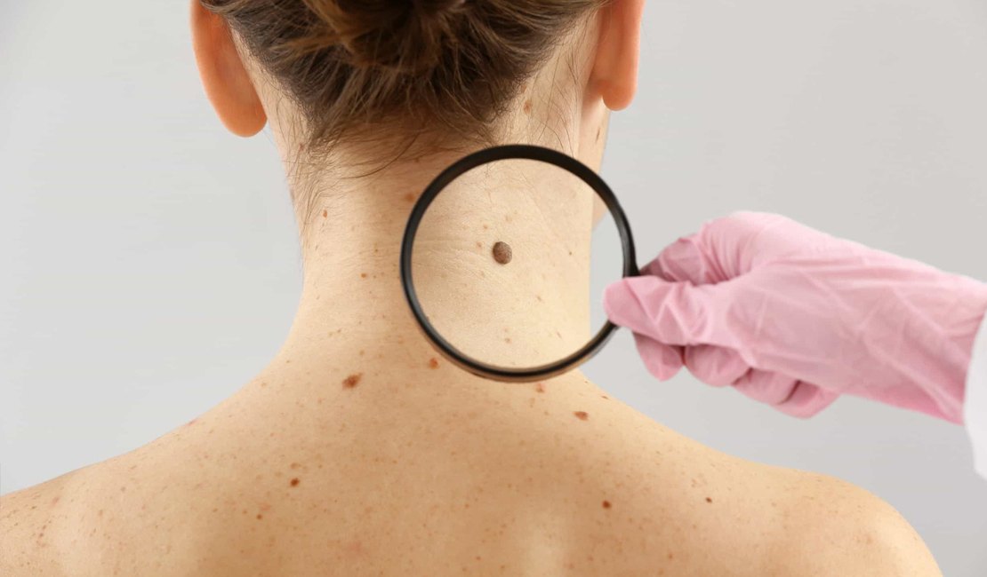 Tecnologia para tratar câncer de pele é aprovada para uso no SUS