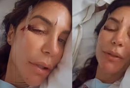 Ivete Sangalo surge em hospital com machucados no rosto e relata susto