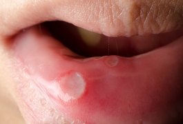 Maio vermelho é o mês de conscientização e combate ao câncer de boca