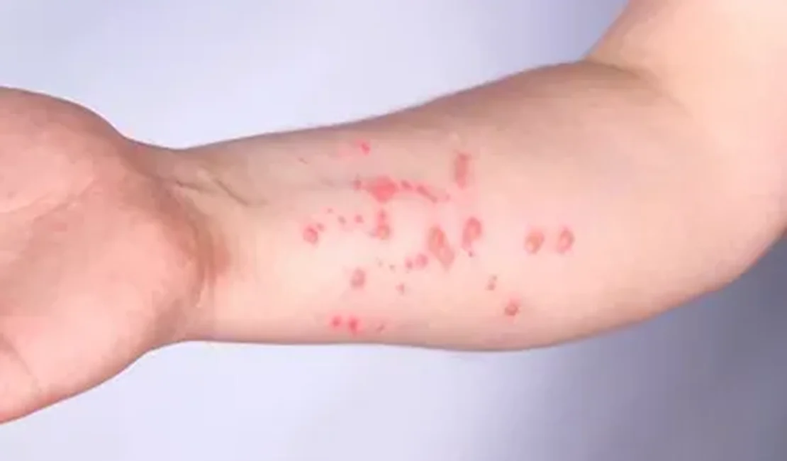 OMS alerta sobre nova variante da mpox e falha do antiviral