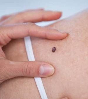 Dezembro Laranja: câncer de pele representa cerca de 30% dos tumores malignos no Brasil