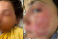 Menina de 10 anos sofre queimaduras graves no rosto após reproduzir desafio viral de rede social