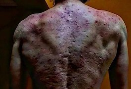 Jovem toma anabolizante e fica com quadro grave de acnes