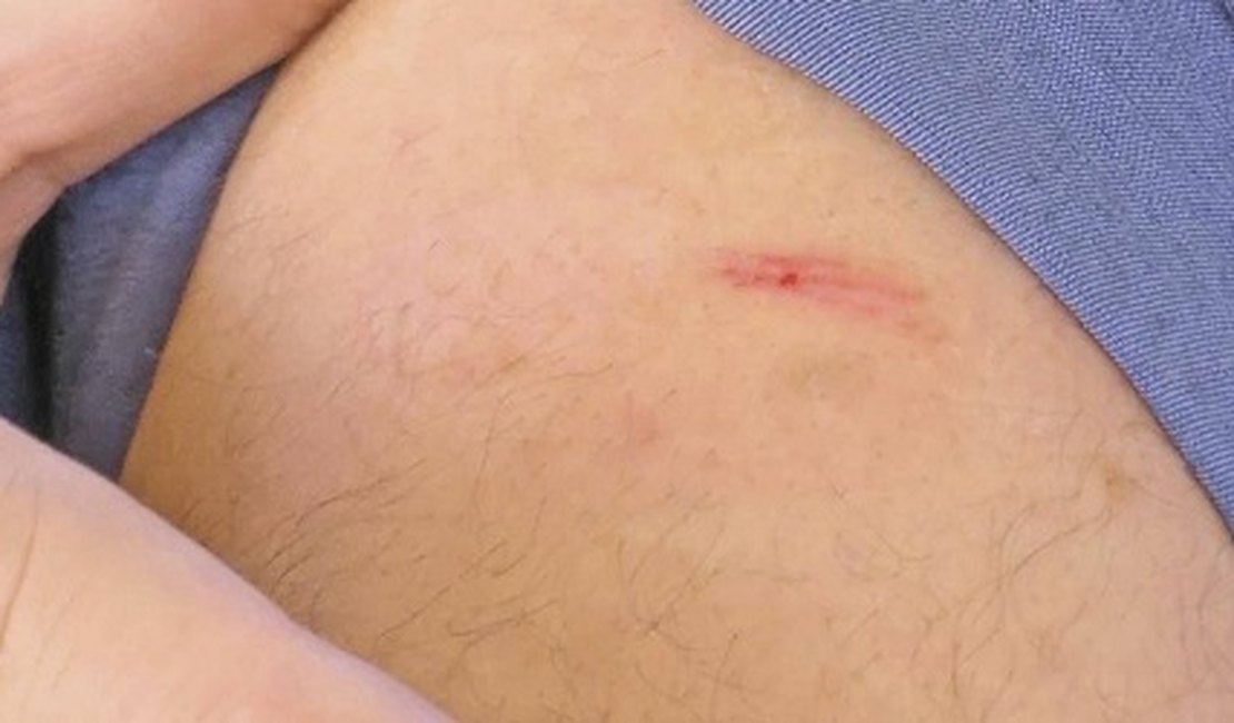 HE do Agreste confirma segundo ataque em Arapiraca com agulha de seringa