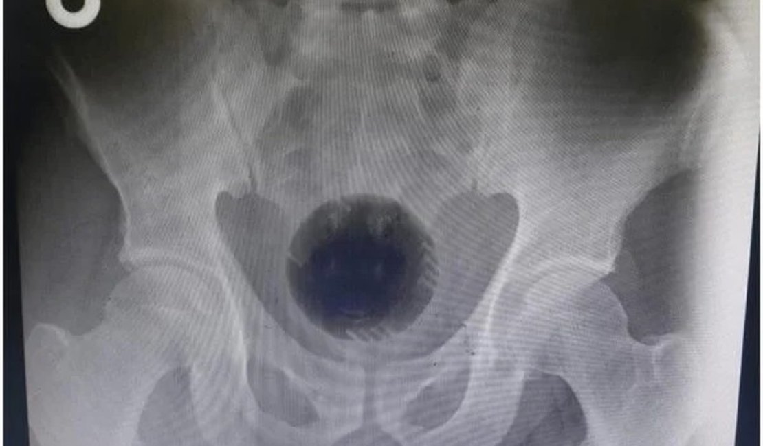 Homem passa por cirurgia para retirar bola de 7 cm presa no ânus