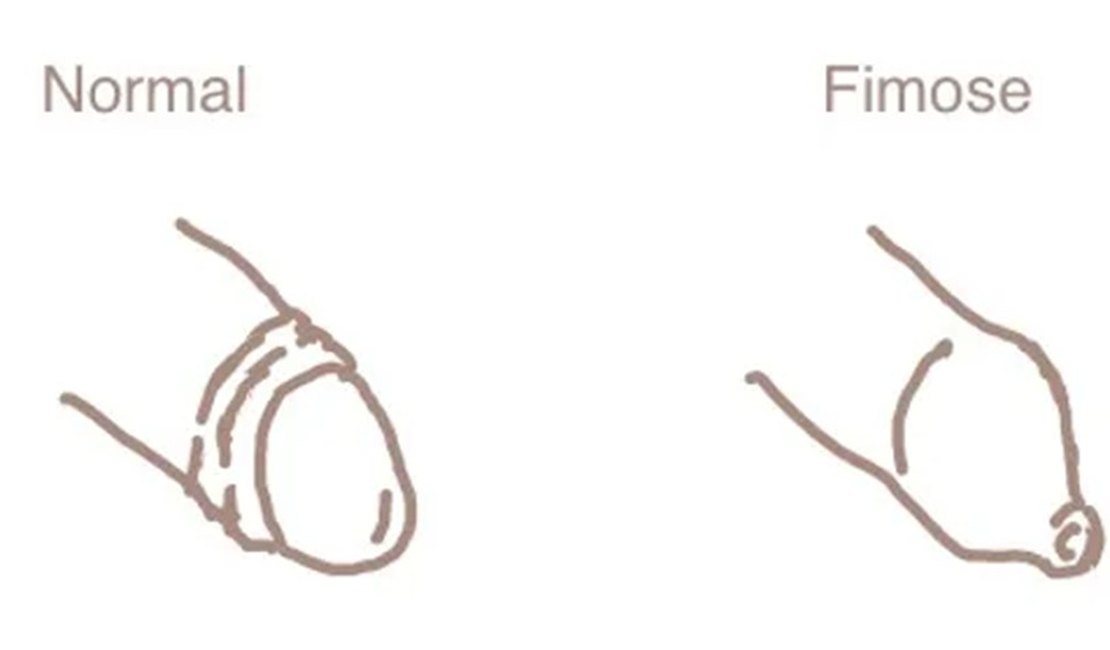 Você tem fimose? O que é a condição que transforma o sexo em agonia para milhares de homens