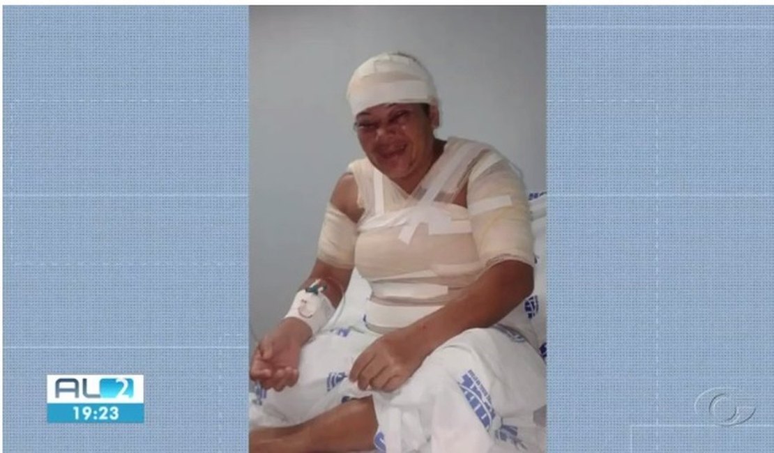 Mulher queimada com ácido pelo ex-companheiro em Marechal recebe alta hospitalar