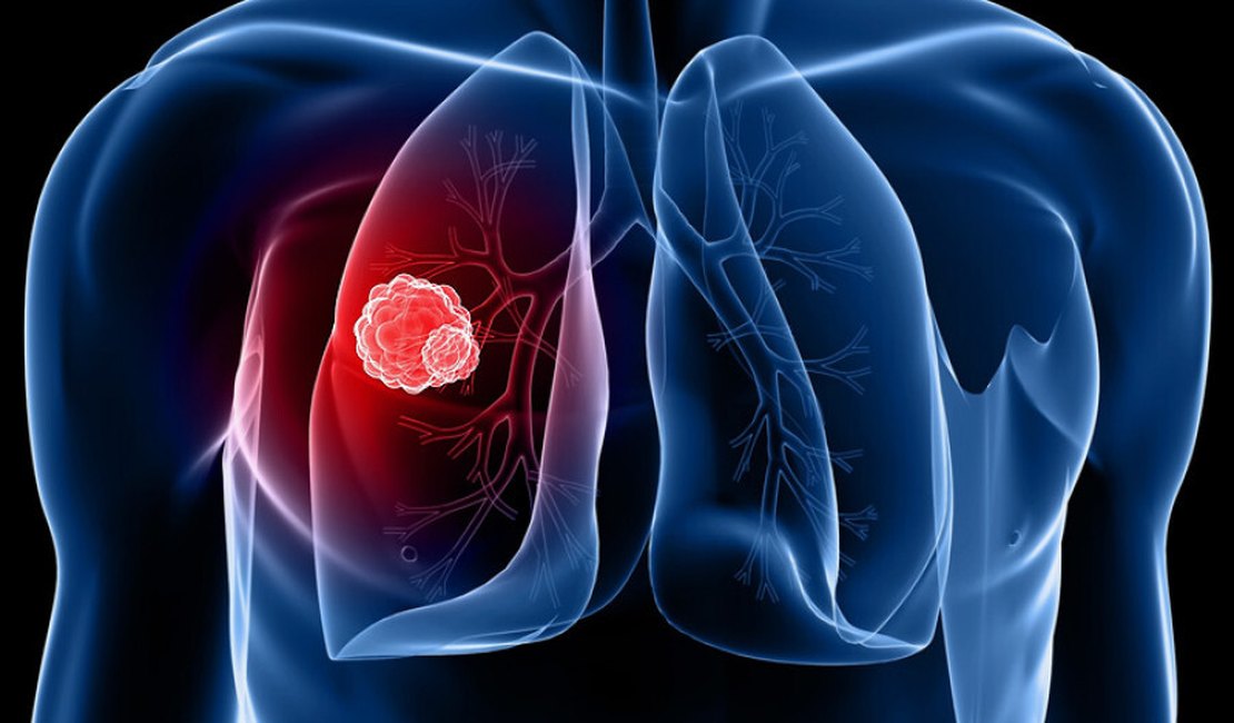 Nova vacina contra câncer de pulmão apresenta resultados promissores