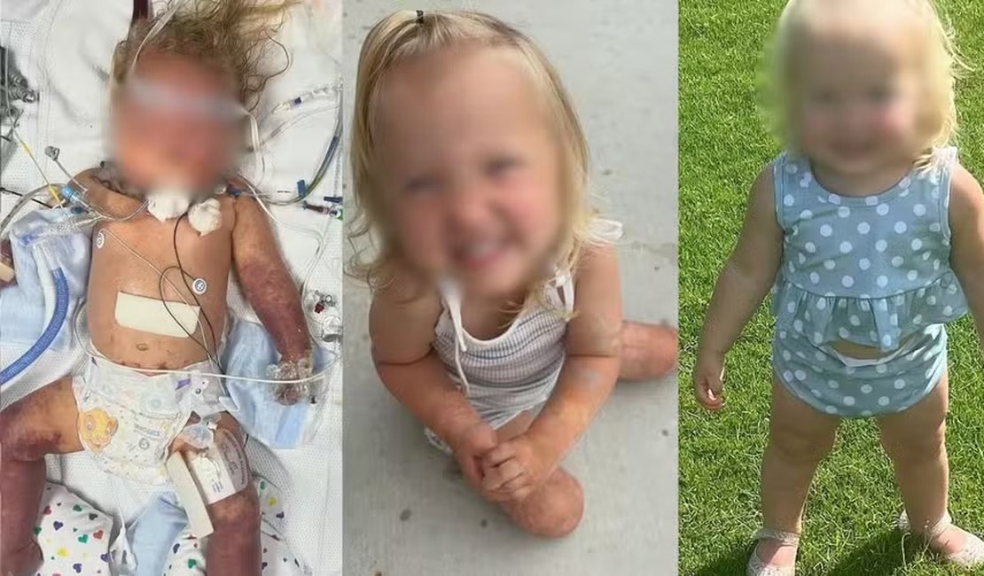 Menina de 18 meses tem as duas pernas amputadas por ter nascido sem um órgão