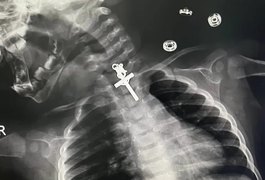 Exame de raio-x revela crucifixo preso dentro de garganta de bebê, no Peru