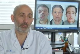 Com doença genética, 'homem de três rostos' faz transplante facial inédito no mundo