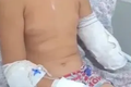 Menino de 10 anos tem parte de braço amputado após acidente em Maribondo