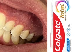 Estabelecimentos comerciais de Arapiraca devem retirar creme dental das prateleiras imediatamente; saiba mais