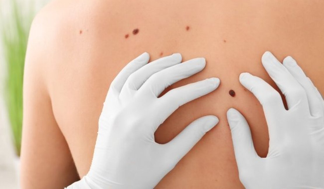 Dia Global alerta para prevenção e diagnóstico precoce do câncer de pele não melanoma