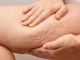 “Celulite de TPM”: por que os furinhos podem parecer mais evidentes antes da menstruação?