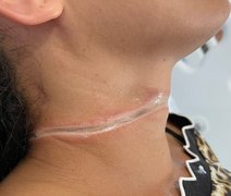 Fiação de internet solta de poste, causa acidente e deixa jovem ferida, no Sertão