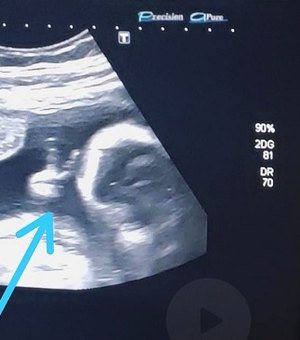Bebê faz 'V de vitória' durante ultrassom e pai com câncer raro vê sinal divino: 'Mais força'