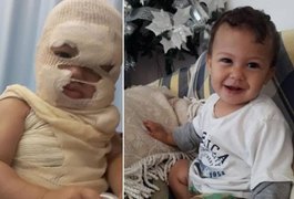 Família pede ajuda para tratar menino de 1 ano vítima de queimaduras, em Alagoas