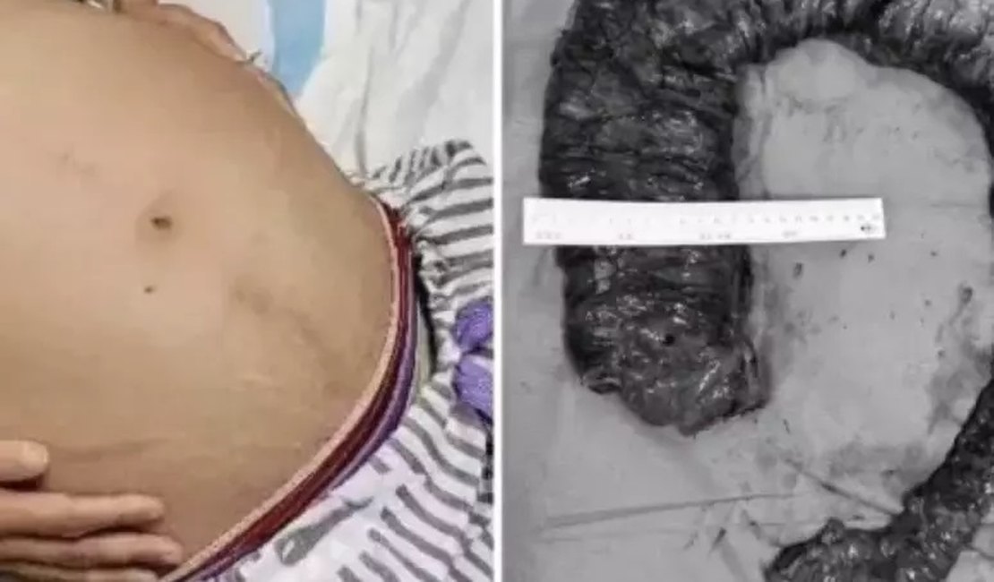 Médicos tiram cocô de 20 kg de intestino de mulher que ficou 10 dias sem evacuar