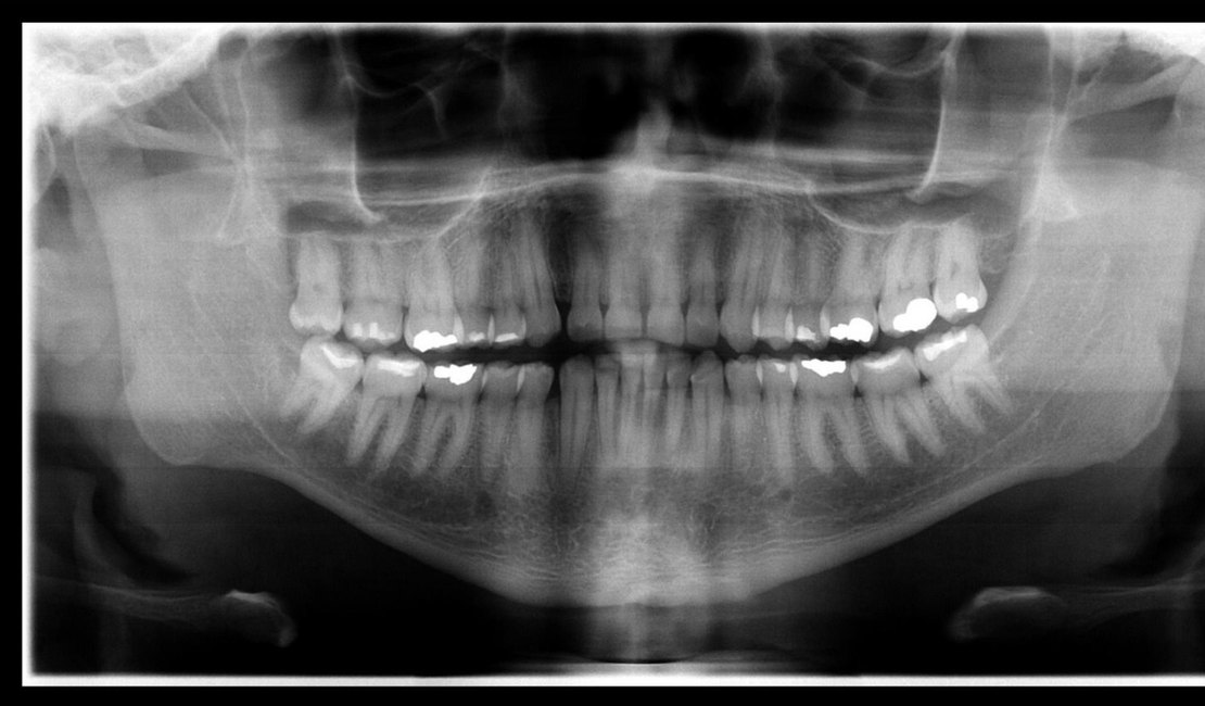 Corpo de enfermeiro do Mato Grosso é identificado por exames odontológicos do IML de Maceió