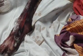 Família pede definição urgente sobre situação de paciente da UPA de Arapiraca; homem apresenta necrose em perna