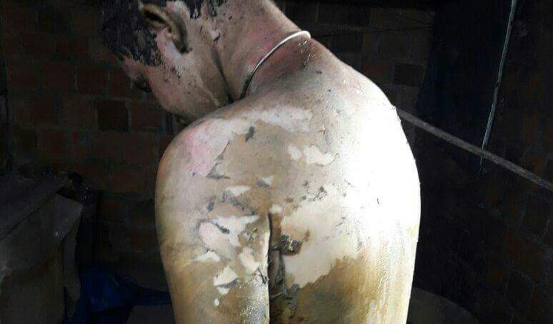 Arapiraquense que teve o corpo queimado está na UTI do HE do Agreste