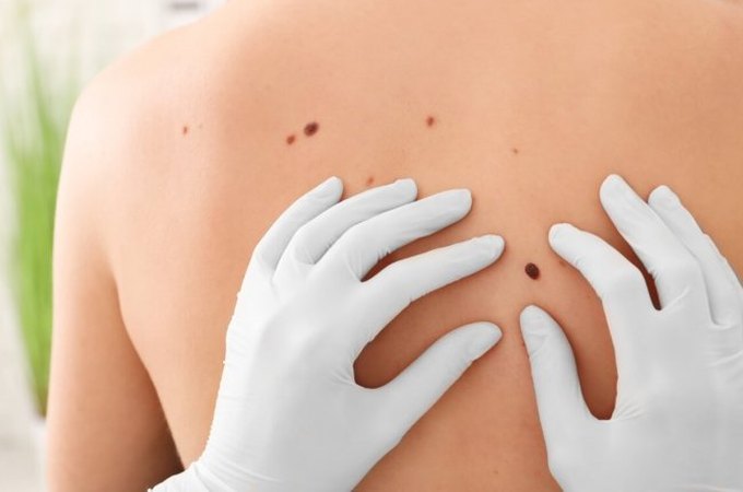 Dia Global alerta para prevenção e diagnóstico precoce do câncer de pele não melanoma