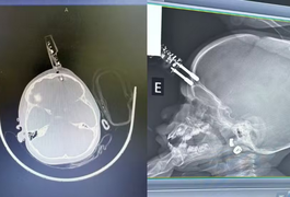 Menina de 1 ano fica com carregador cravado na testa após cair da cama em MG