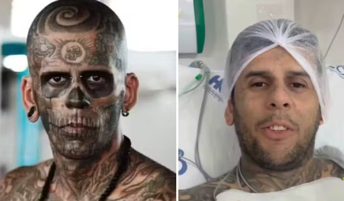 Câncer de bexiga invasivo: entenda tratamento e prognóstico de doença que atinge ‘homem mais tatuado do Brasil’
