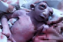 Bebê nasce sem metade da cabeça e surpreende os médicos ao viver 48 horas